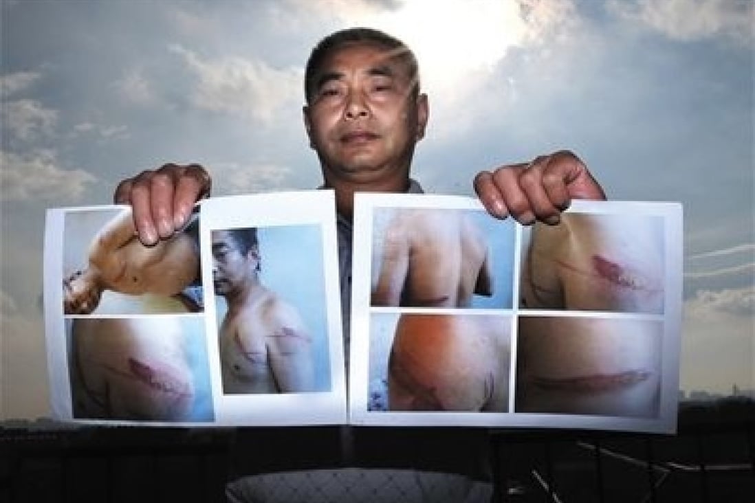 Wang presents photos showing long streaks of burn marks and scars on his body.  