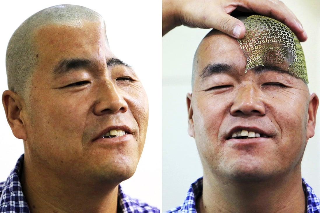 The man, surnamed Hu, lost part of his head in an accident but will now be surgically fitted with a new skull. Photos: Reuters