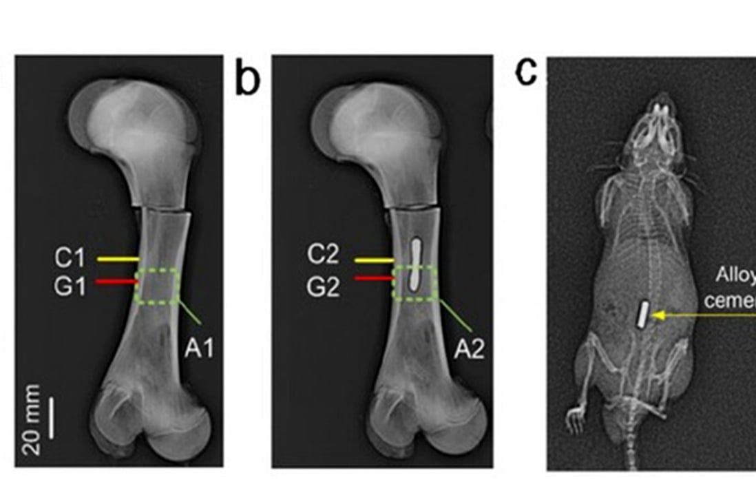 Chinese researchers test metal alloy to fix broken bones in minutes South China Morning Post
