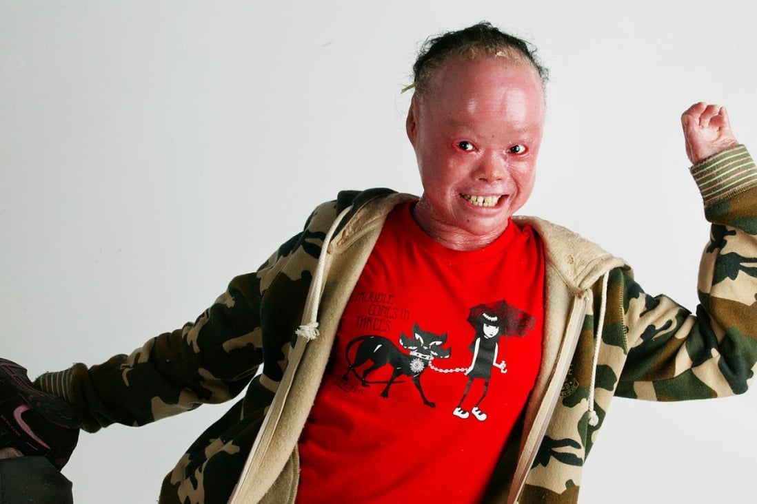 Mui Thomas is a special referee - the world's first rugby umpire living with Harlequin ichthyosis, a rare congenital skin disorder. Photo: Nora Tam