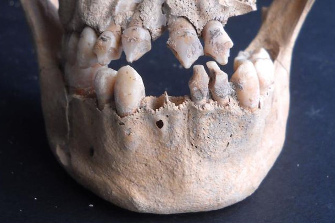 Teeth from the remains of African slaves show evidence of cultural modification. A new study traced the DNA from three sets of remains to their region of origin in Africa. Photo: Hannes Schroeder / Natural History Museum of Denmark