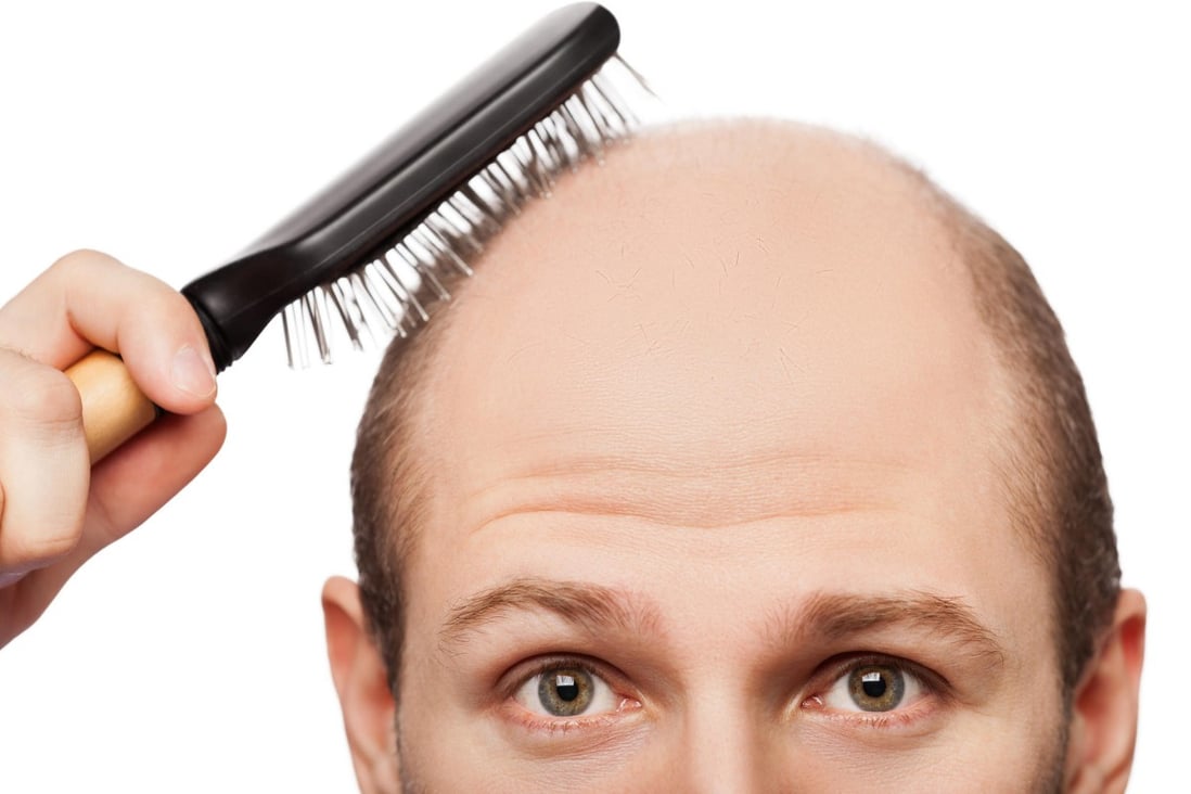 Trick to regrowing lost hair might be tearing out what you have left | South China Morning Post Trick to regrowing lost hair might be tearing out what you have left | South China Morning Post