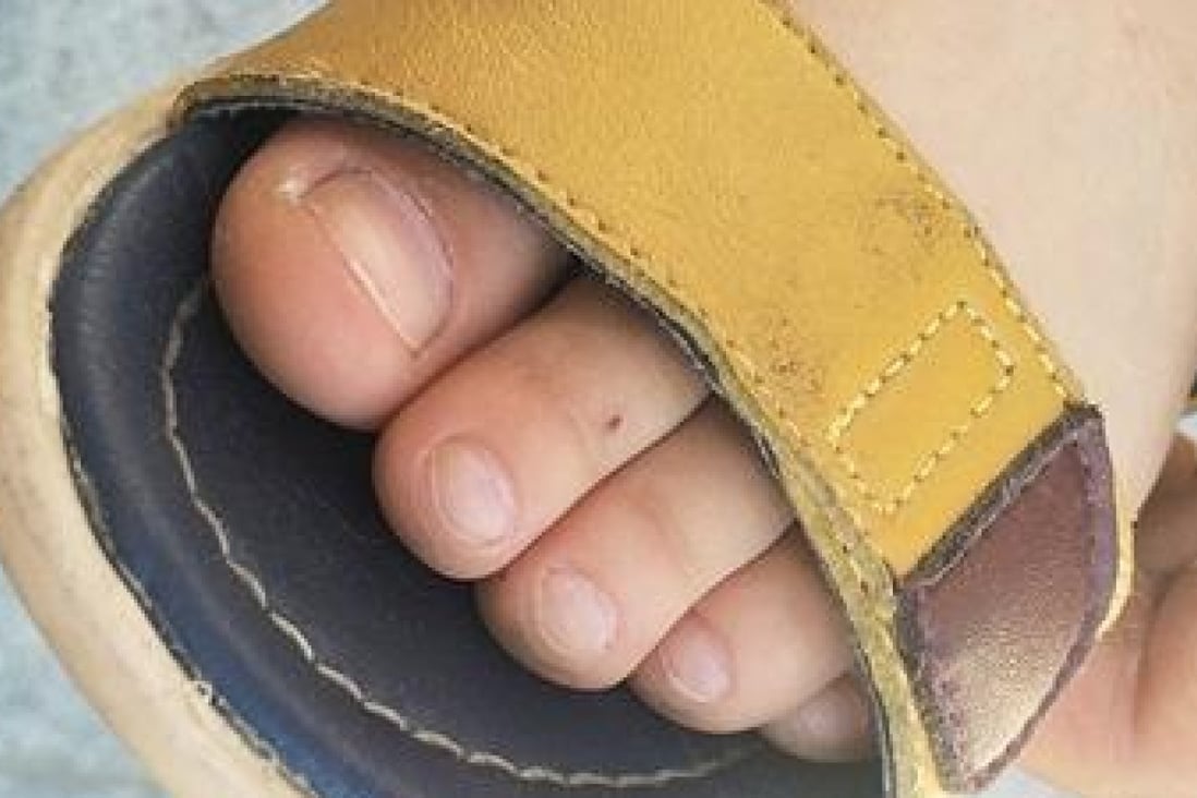 An alleged needle mark in the foot of one of the Bejiing kindergarten pupils. Photo: The Beijing News