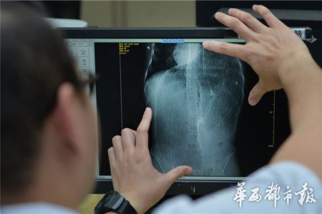 Doctors at Chengdu's No 2 Hospital view an X-ray of the patient's colon. Photo: 163.com
