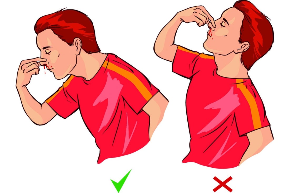 The right and wrong way to stem a nosebleed. Illustration: Corbis