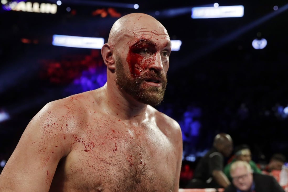 Tyson Fury of England gets a cut over his right eye in a heavyweight boxing tune-up match against Otto Wallin of Sweden in Las Vegas in 2019, Photo: AP  
