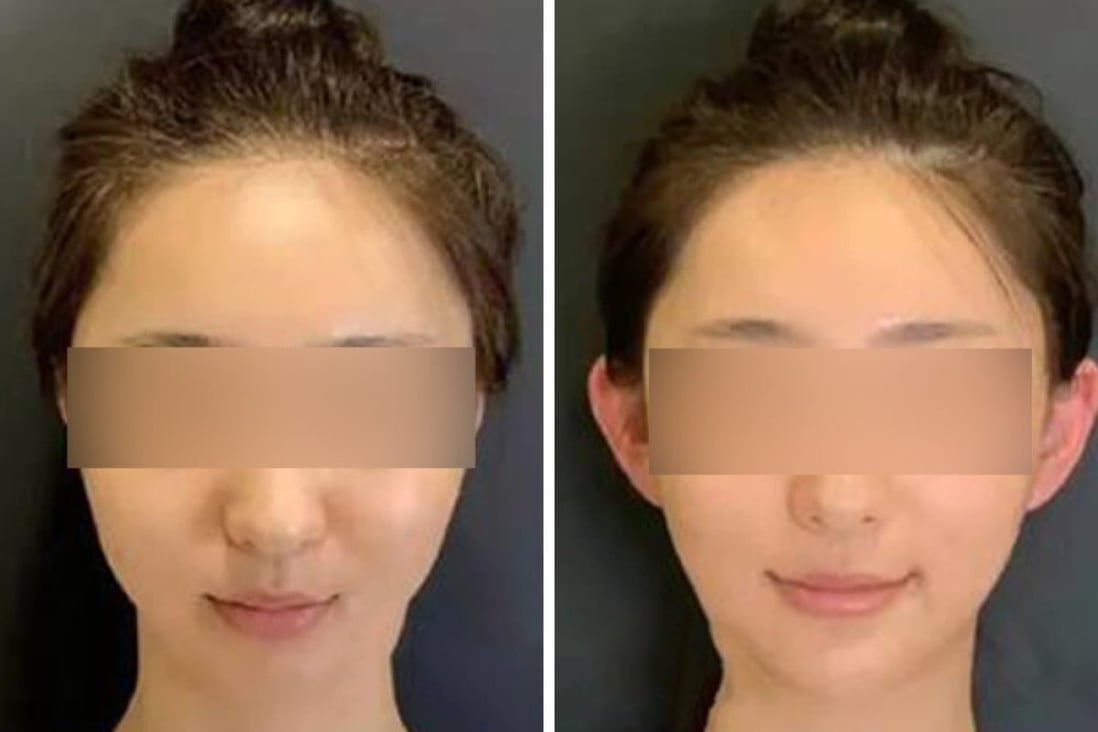 scmp South China Morning Post
- China’s ‘elf ear’ cosmetic surgery increasingly sought by young people seeking a thinner, slimmer face
welfare/article/3136795/chinas-elf-ear-cosmetic-surgery-increasingly https://www.scmp.com/news/people-culture/social-welfare/article/3136795/chinas-elf-ear-cosmetic-surgery-increasingly