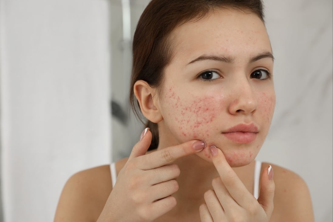 Don’t pop pimples with your fingers - clear the skin with an alcohol swab, put on gloves, poke a tiny hole in the centre and squeeze upwards with two Q-tips to avoid infecting the area, one expert says. Photo: Shutterstock