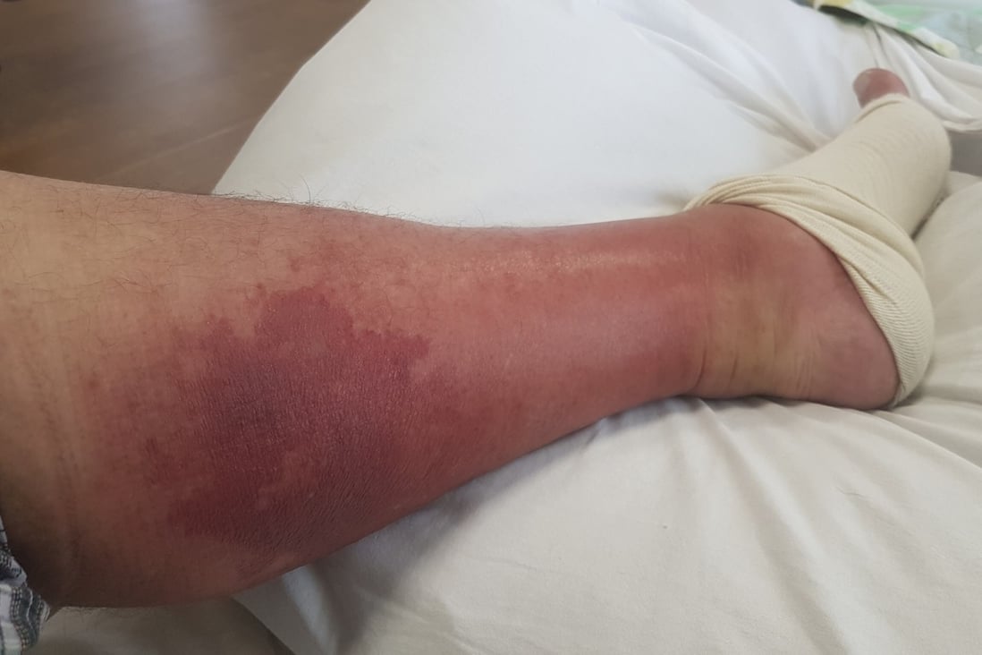 Martin Williams’ left leg doubled in size and turned purple after he contracted cellulitis, likely the result of stepping on a small sea creature at Cheung Sha beach on Lantau Island in Hong Kong. Photo: Martin Williams
