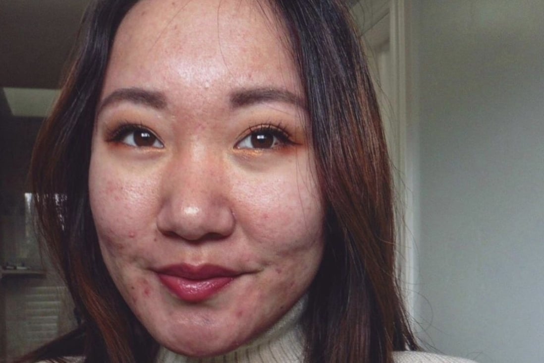 Katie Gu , who still battles severe breakouts at 23, is a skin positivity influencer helping those with severe acne learn to feel good in their own bodies. Photo: Instagram/@asianacnegirl