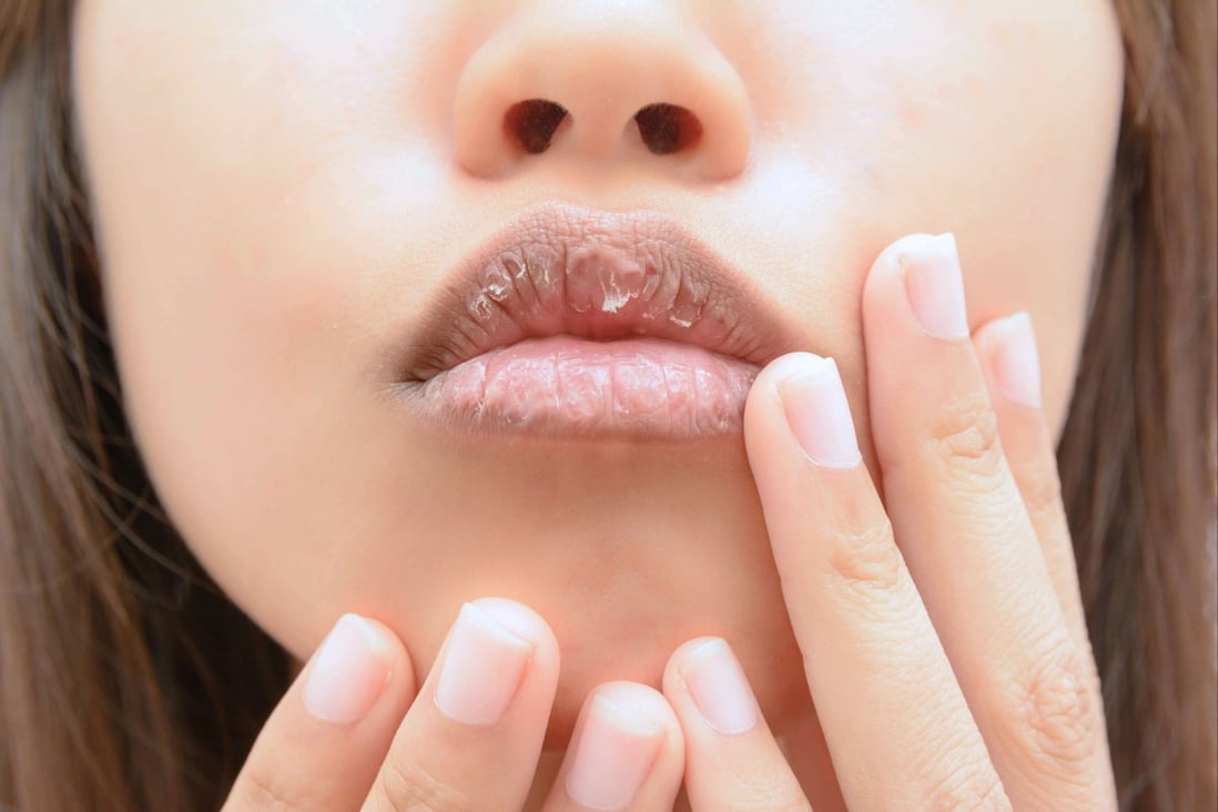 Dry, chapped lips are both uncomfortable and visually displeasing, and make you more vulnerable to painful and unsightly blisters. Photo: Shutterstock