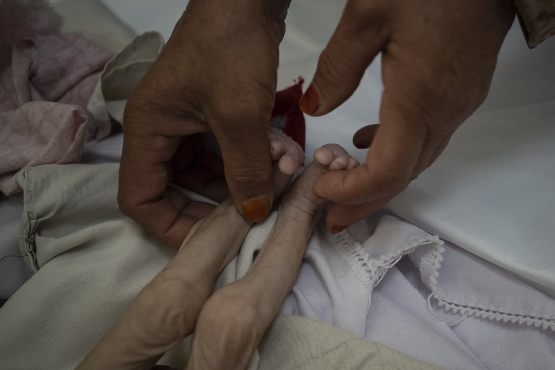The stepmother of Mohammed, a four-month-old who is malnourished, holds his legs in the Indira Gandhi hospital in Kabul, Afghanistan on November 8.The number of people living in Afghanistan in near-famine conditions has risen to 8.7 million, according to the World Food Programme. Photo: AP