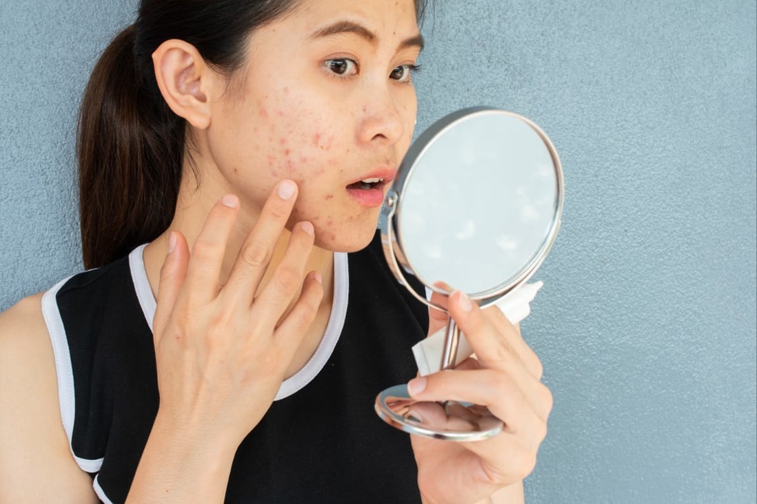 Five sneaky reasons your skin may be struggling with breakouts, and simple fixes for them. Photo: Shutterstock