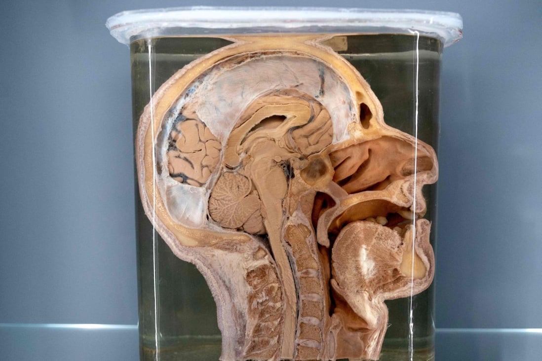 An exhibit from the anatomical pathology collection, which includes some 50,000 human remains, at Vienna’s Natural History Museum on October 20, 2021. Photo: AFP