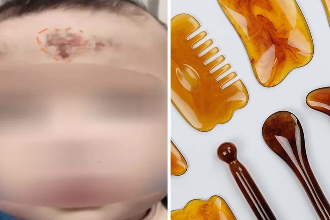 A baby girl has wound up in hospital after her Chinese grandma used TCM to try and cure a cough. Photo:  Baidu