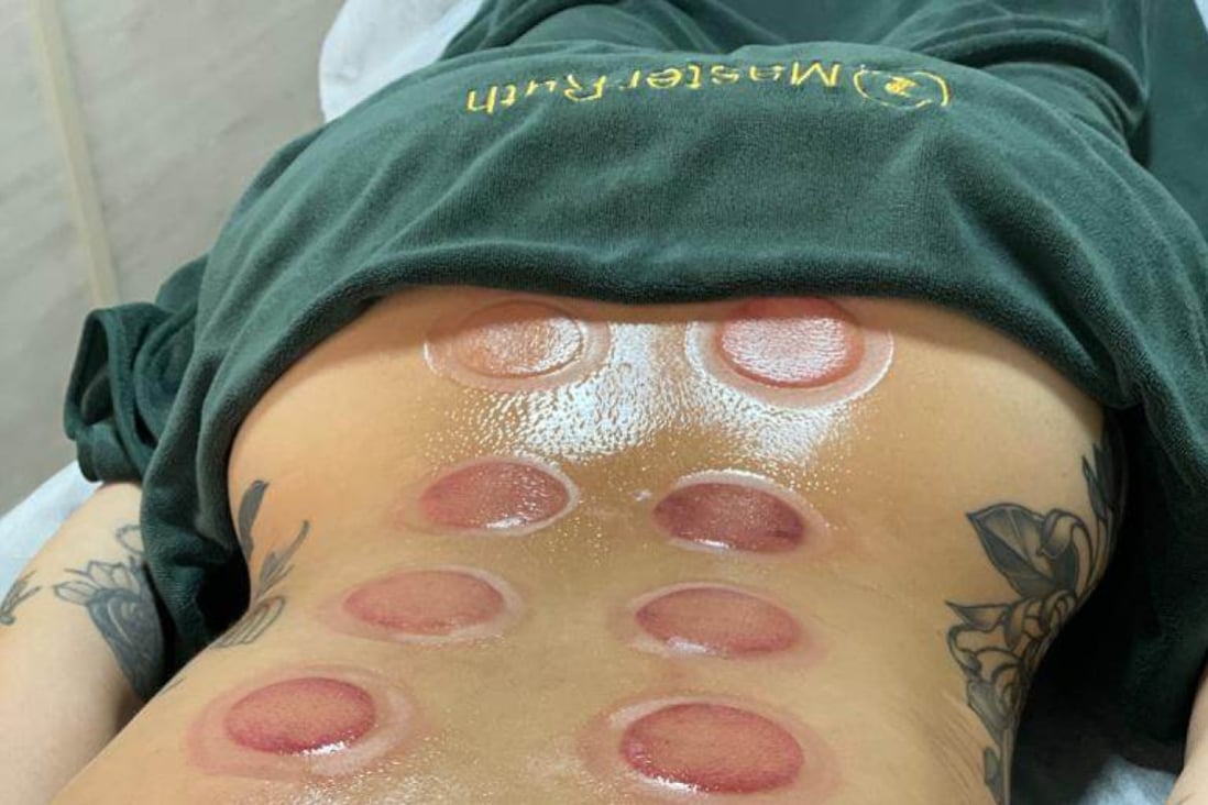 Olympians are getting cupping as a way to recover from hard workouts ahead of Beijing 2022. Photo: Ruth Lee