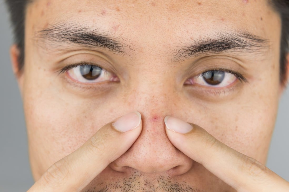 How to Pop a Zit in Your Nose: A Gentle & Effective Guide