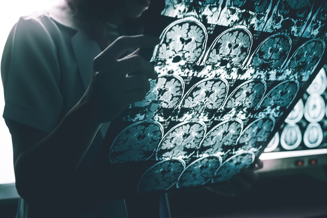 An Oxford University study of 785 UK Biobank subjects found those who had been infected with Covid-19 had a 1.3-1.8 per cent loss of grey matter  compared to an estimated 0.2 to 0.3 per cent loss of brain volume a year in normal middle-aged individuals. Photo: Shutterstock