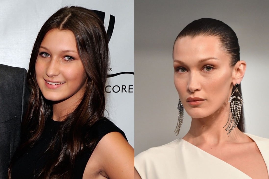 Bella Hadid has revealed she had a nose job at 14. That, and the number of procedures on teenagers in 2021, has triggered a debate on teen plastic surgery.