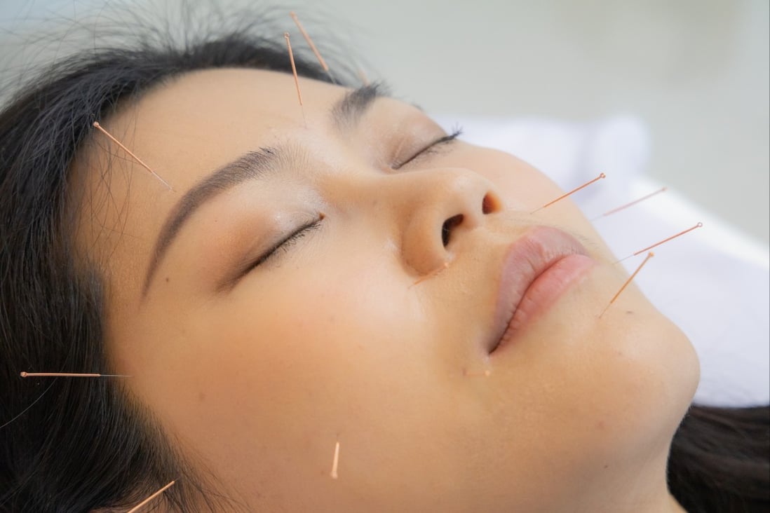 Acupuncture is the traditional Chinese medicine practice of inserting needles into the skin. Photo: Shutterstock