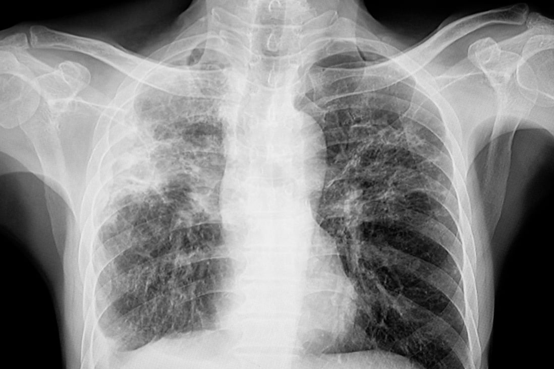 For countries with a high burden of latent TB infection, such as China, having a vaccine to prevent the onset of disease would be crucial. The World Health Organization says the Covid-19 pandemic has disrupted TB notifications. Photo: Shutterstock Images