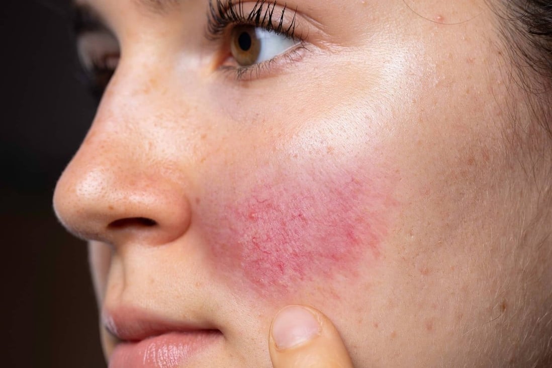 What is rosacea? Causes, symptoms and treatments of a disease that ...