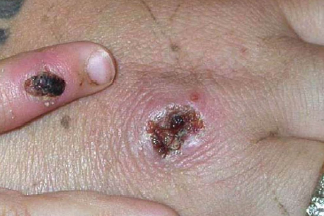 Symptoms of the monkeypox virus on a patient’s hand. File photo: TNS