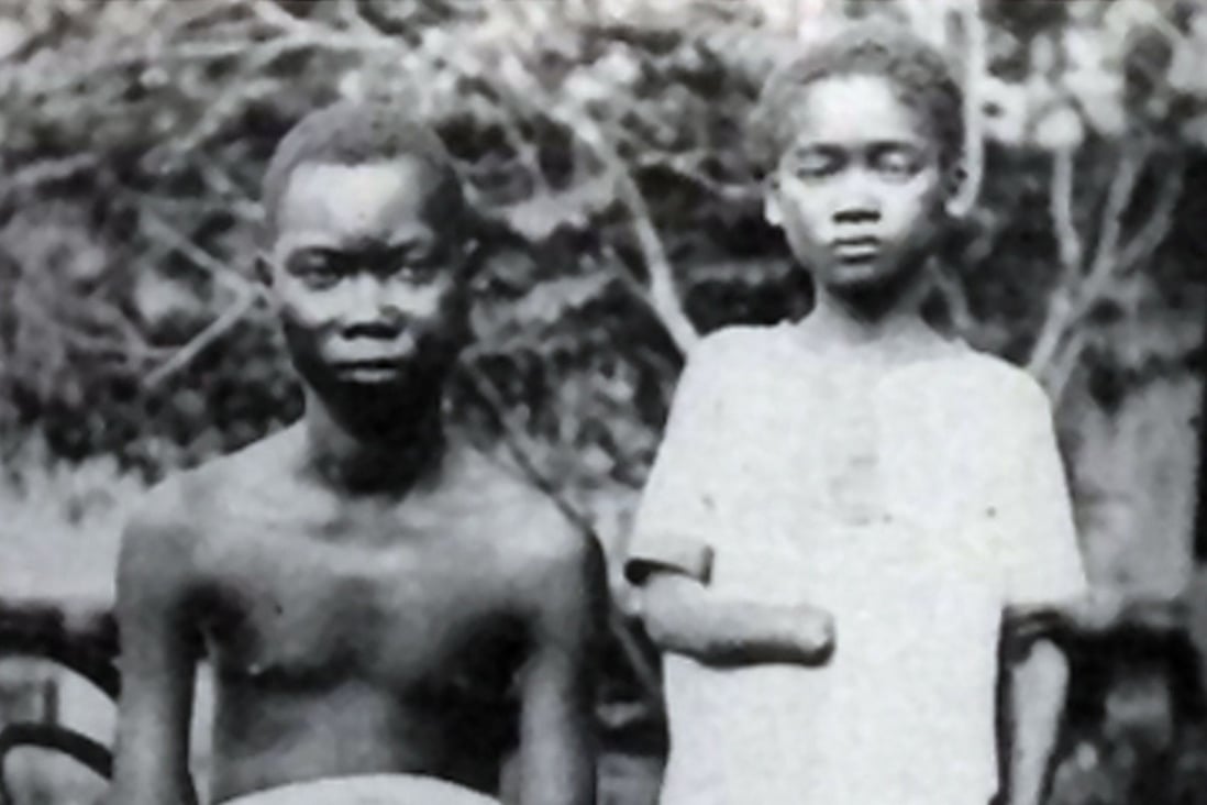 Amputation was frequently used to punish workers in the Congo Free State, controlled by Leopold II of Belgium. File photo: Universal History Archive