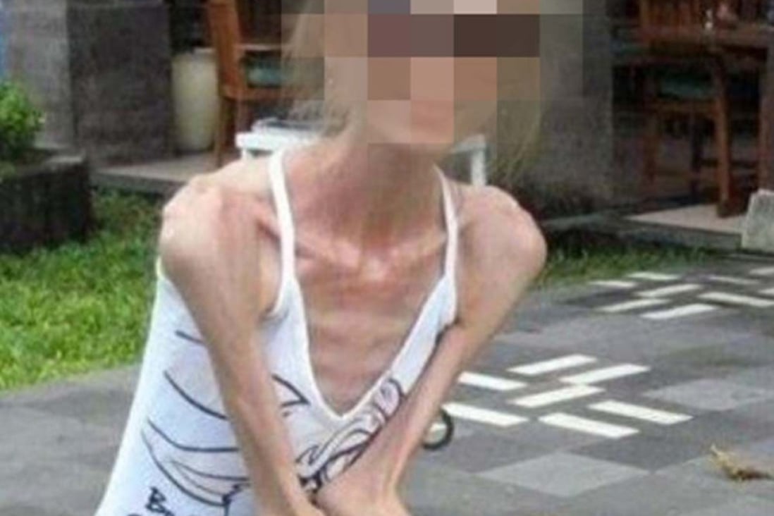 Anorexic young mother of two in China weighing 25kg admitted to ICU with multiple organ failure. Photo: Handout Anorexic young mother of two in China weighing 25kg admitted to ICU with multiple organ failure. Photo: Handout