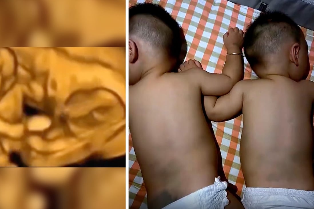 An edited video that showed two twins “fighting” in their mother’s womb went viral in China. Photo: SCMP composite.
