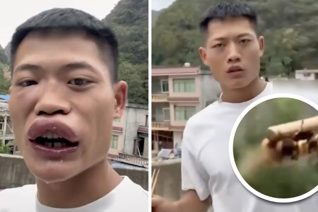 A Chinese influencer is kicked off his Douyin account for posting a video of himself eating a wasp, causing swollen lips and difficulty swallowing. Photo: SCMP composite