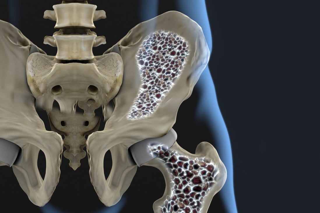 A porous hip bone (left) shows signs of osteoporosis, which raises the chance of hip fracture after a fall. Photo: Shutterstock