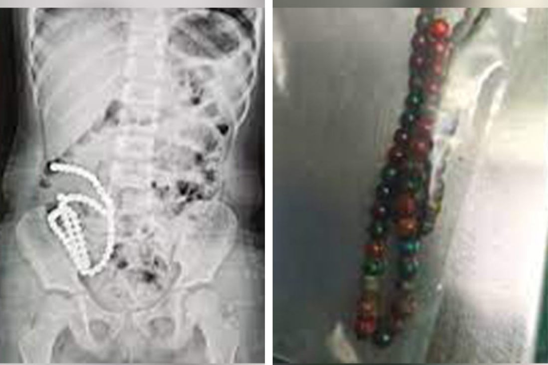 Surgeons in eastern China had to operate on a four-year-old girl for three hours to remove 61 magnetic beads she from her stomach which she had swallowed. Photo: SCMP Composite.