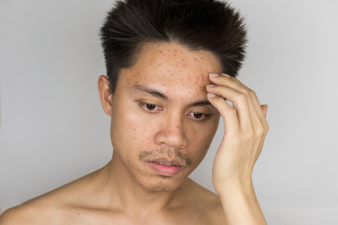 Adult acne can have a number of causes, but there are ways to treat it. Photo: Alamy