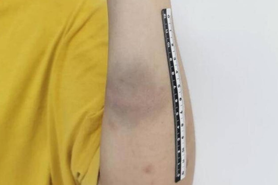 A woman who was beaten with an iron bar by her mother displays one of the injuries to her arm. When police arrived at the scene they found her bruised and bleeding with wounds to her arms, buttocks and legs. Photo: Weibo