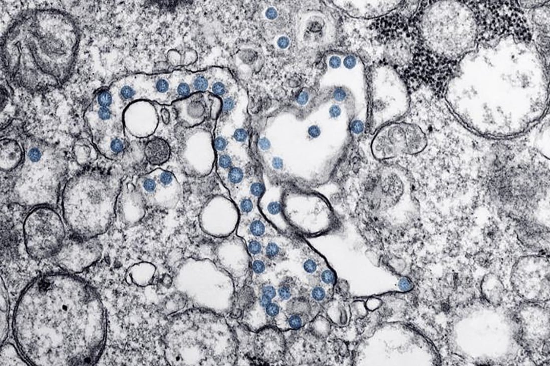 Pictured is a transmission electron microscopic image of an isolate from the first US case of the Covid-19 coronavirus, with the spherical viral particles, colourised blue, containing cross-sections through the viral genome, seen as black dots. At least 20 countries have reported their first coronavirus cases in the past week. Photo: Hannah A Bullock and Azaibi Tamin/Centres for Disease Control and Prevention handout/AFP