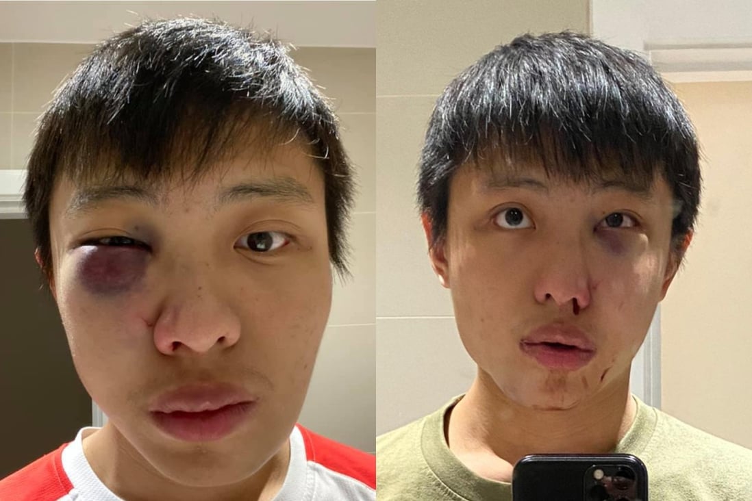 Jonathan Mok, who said he has been studying in London for two years, posted two photos of himself showing a swollen eye on his Facebook page. Photo: Handout