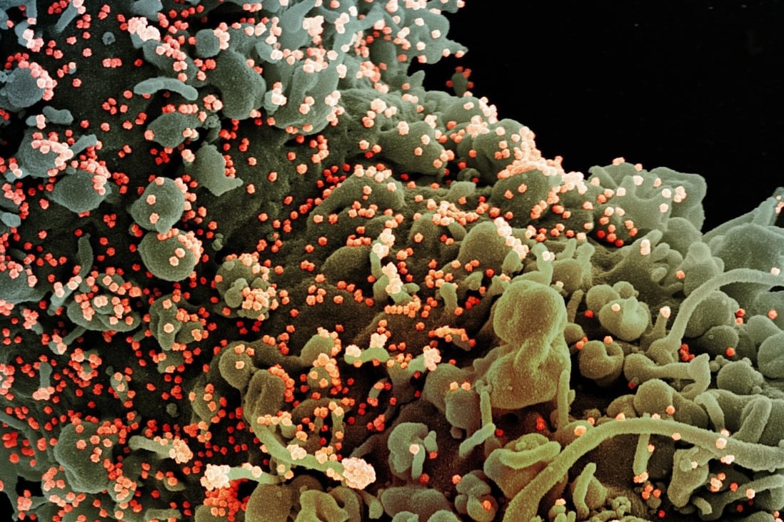 A colourised scanning electron micrograph of a cell infected with SARS-COV-2 virus particles (orange). Photo: EPA-EFE/NIAID/National Institutes of Health handout