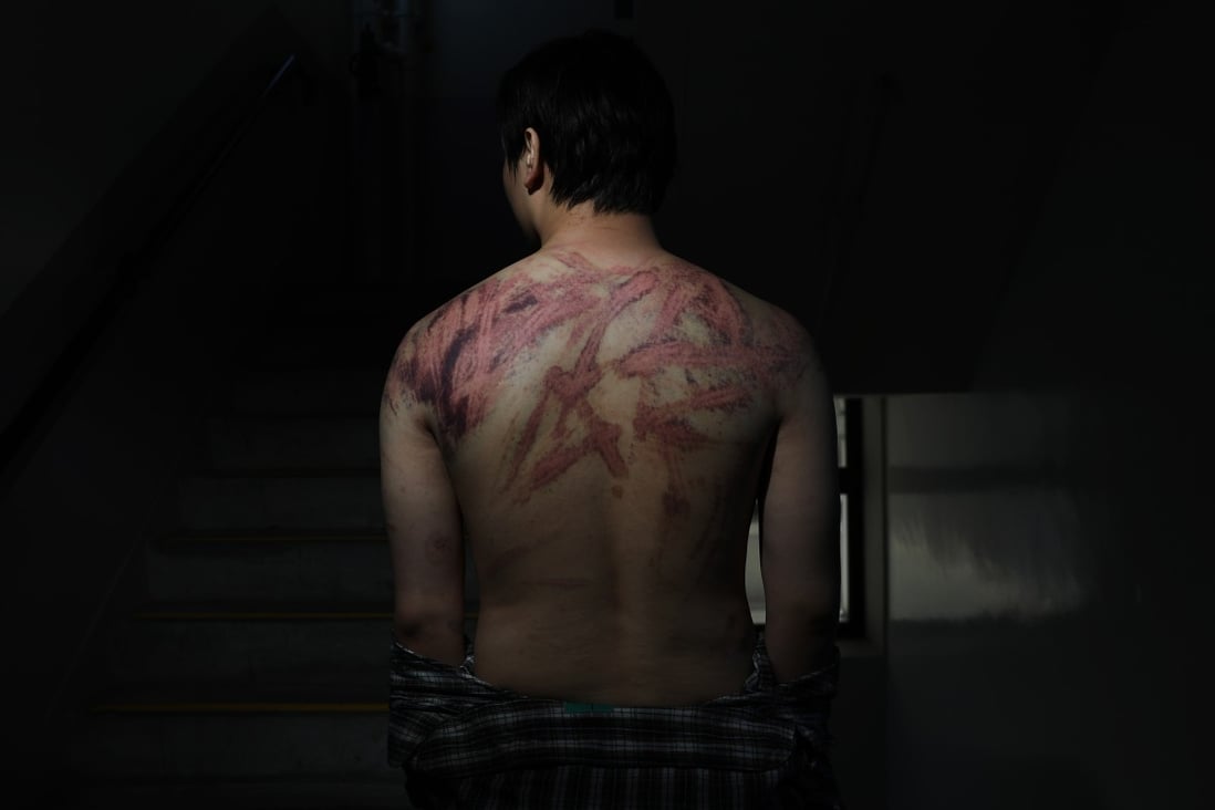 Post photographer Sam Tsang earned a joint first place award for his portrait of Calvin So, a 23-year-old chef beaten with sticks and canes by a group of white T-shirt-clad men at the Yuen Long MTR station on July 21. Photo: Sam Tsang