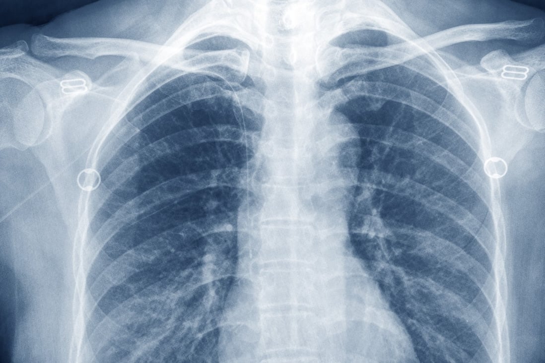 Could X-ray technology be reapplied as a treatment for coronavirus patients? One US study of 10 patients suggests it might have a place, but other experts recommend extreme caution should be exercised around radiation therapy. Photo: Shutterstock Images