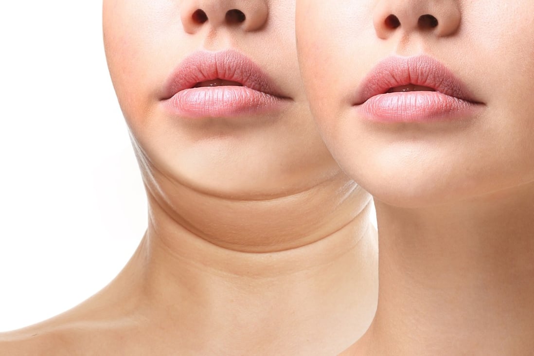 A woman is shown with a double chin (left) and a smooth chin (right) thanks to plastic surgery. The coronavirus pandemic has caused a boom in plastic surgery. Photo: Shutterstock