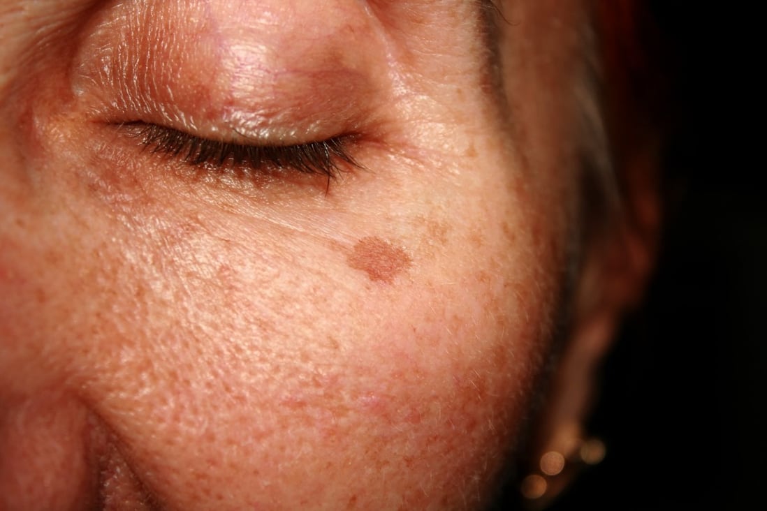 Dark spots, marks and blemishes: hyperpigmentation explained, and five ...