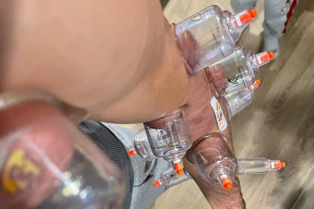 Tony Ferguson shows off his arm while receiving cupping therapy treatment after his UFC 256 defeat by Charles Oliveira. Photo: Instagram