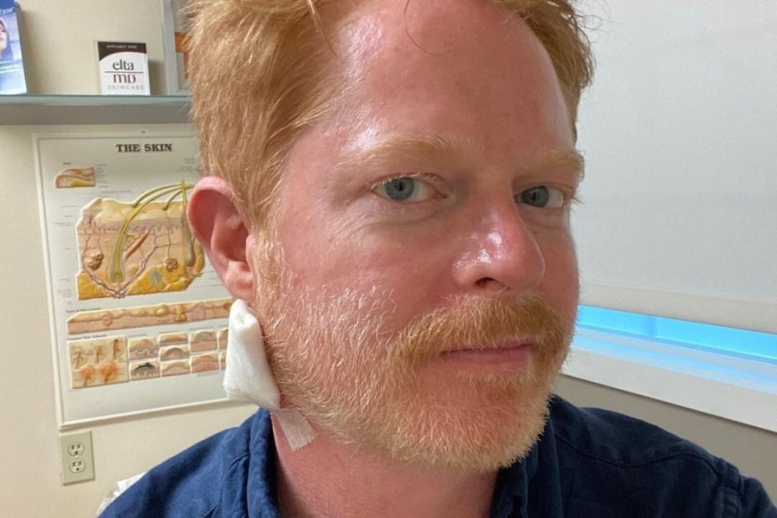 Jesse Tyler Ferguson got ‘a bit of skin cancer’ removed during a visit to a dermatologist and went on Instagram to warn others to put on high-SPF sunscreen.