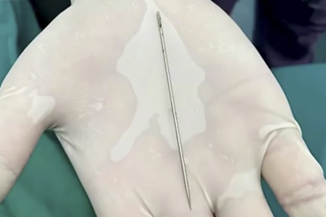 This needle was removed from a teenage boy’s urethra in eastern China. Photo: Weibo