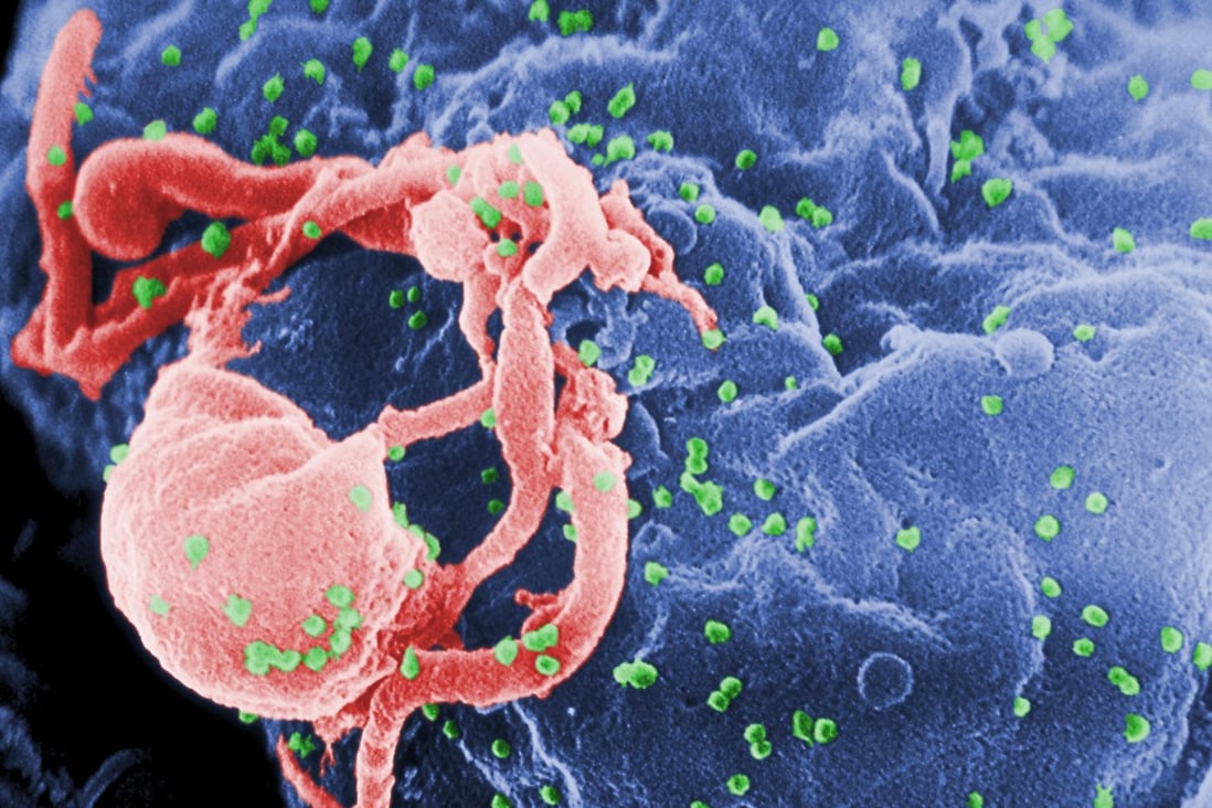 A scanning electron micrograph shows multiple round bumps of the HIV-1 virus on a cell surface. Image: US Centres for Disease Control and Prevention via AP