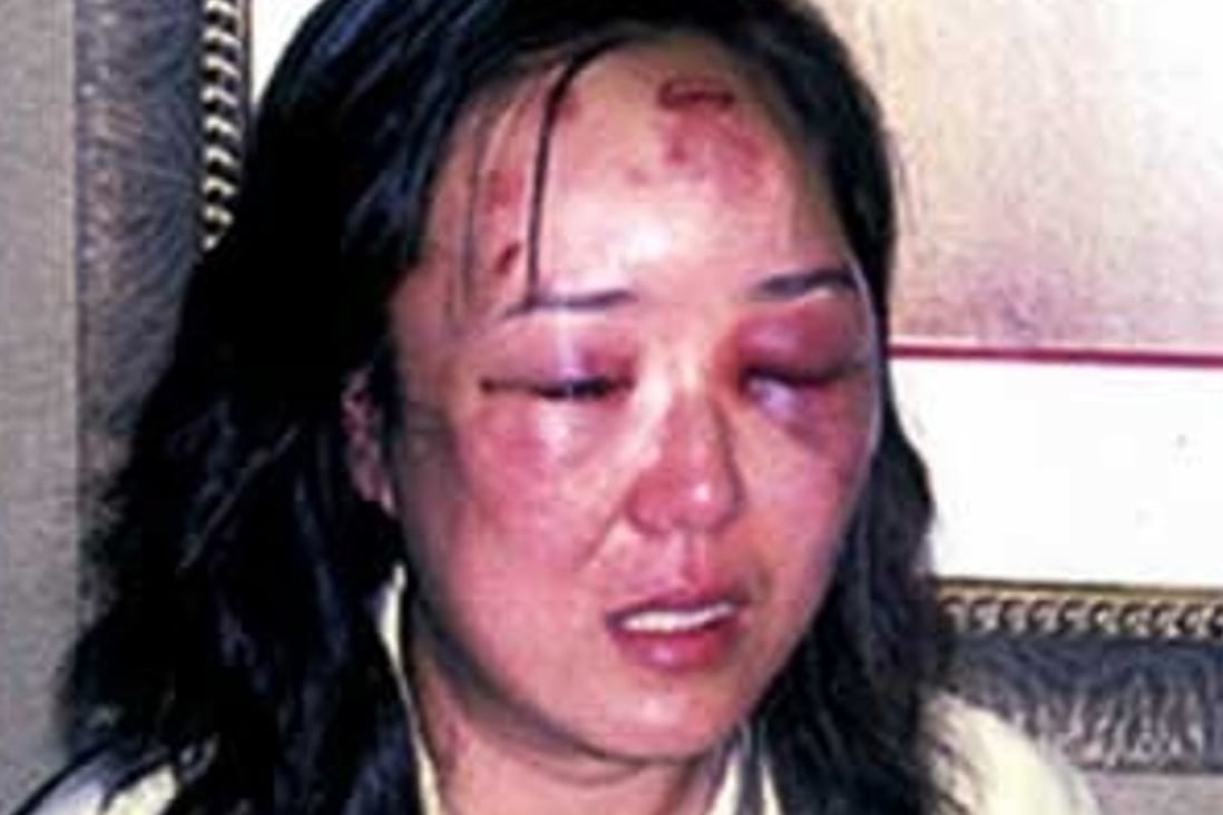Tianjin businesswoman Zhao Yan displays the injuries she received at the hands of a US border agent in 2004. Photo: Xinhua