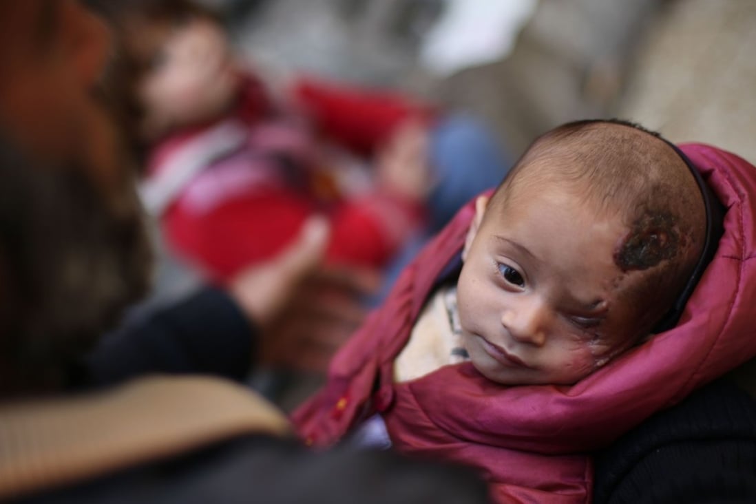 A picture taken on December 4 shows Syrian baby Karim Abdallah who lost his left eye and his mother in government shelling on the town of Hammuriya. Photo: Agence France-Presse