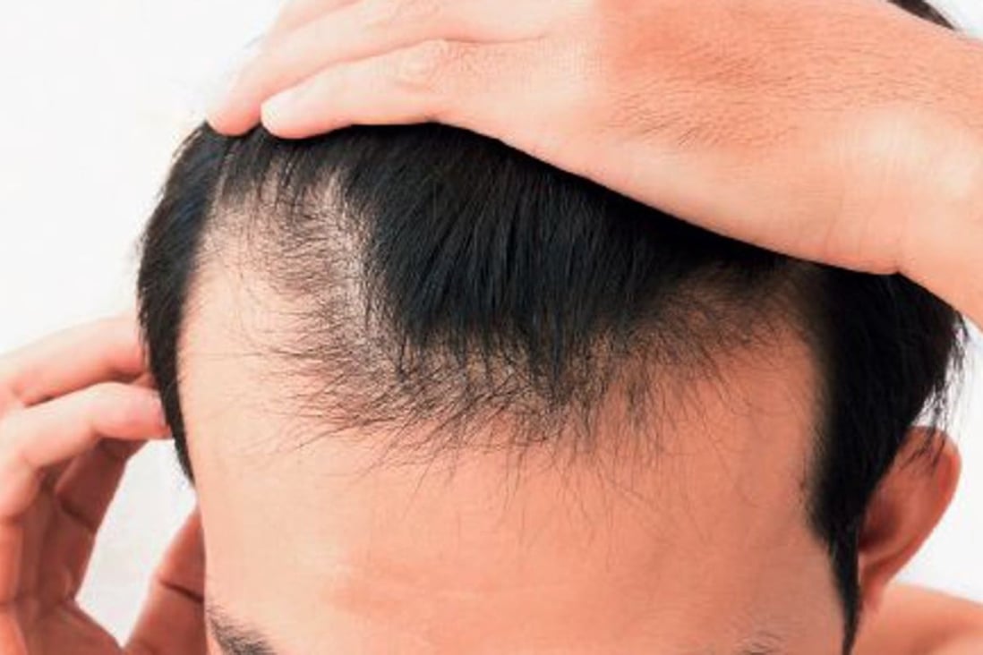 Chinese people are starting to lose their hair at an earlier age than in previous generations, according to recent research. Photo: Sina.com