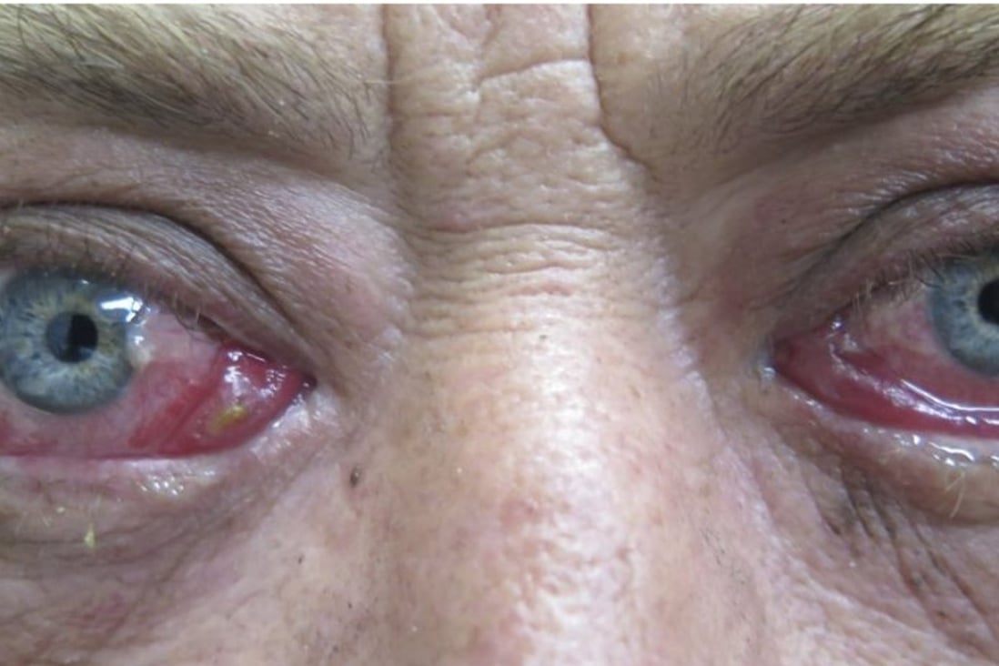 A patient with acute thyroid eye disease.